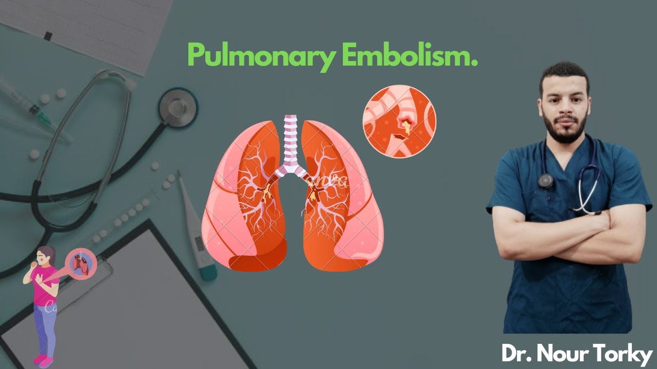 5-Pulmonary Embolism I الجلطة الرئوية