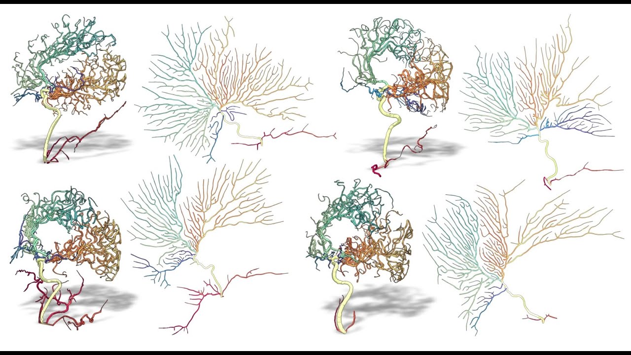 Untangling vascular trees for surgery and interventional radiology - Guillaume Houry - Shape seminar