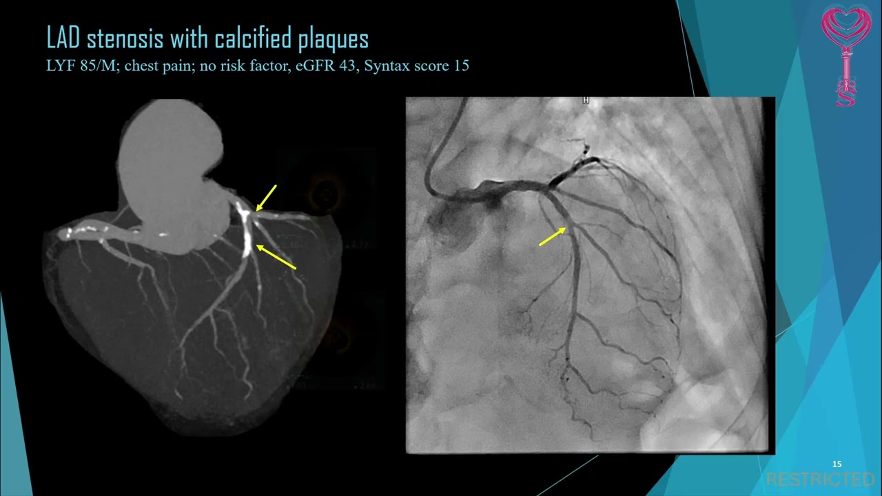 Sponsored symposium: The use of photon counting CT in guiding percutaneous coronary intervention