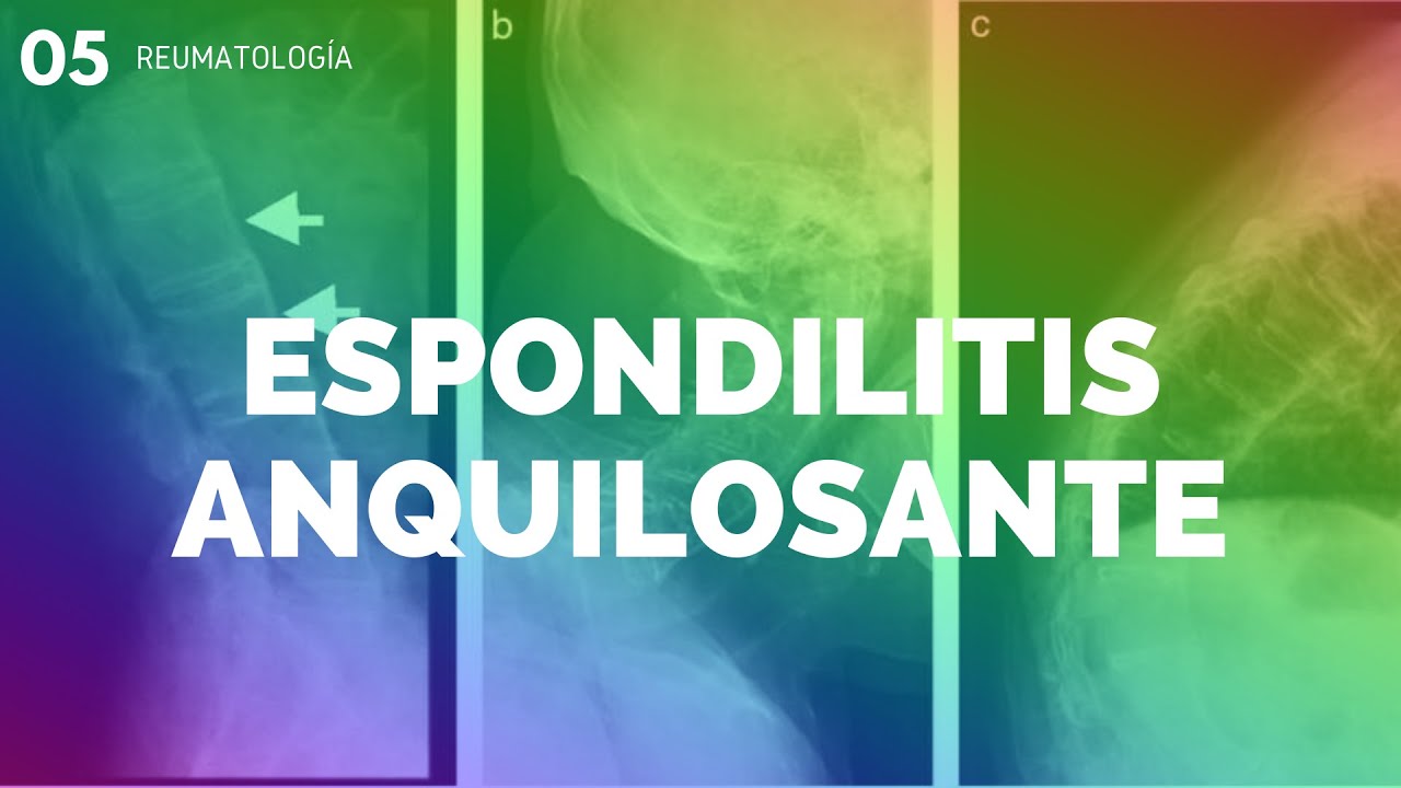 ESPONDILITIS ANQUILOSANTE - ENARM