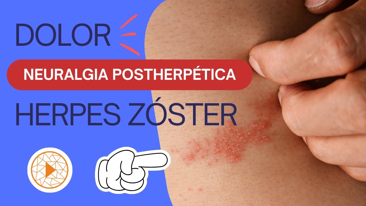 ¿DOLOR DESPUÉS DEL HERPES ZOSTER? Todo lo que necesitas saber sobre la neuralgia postherpética.