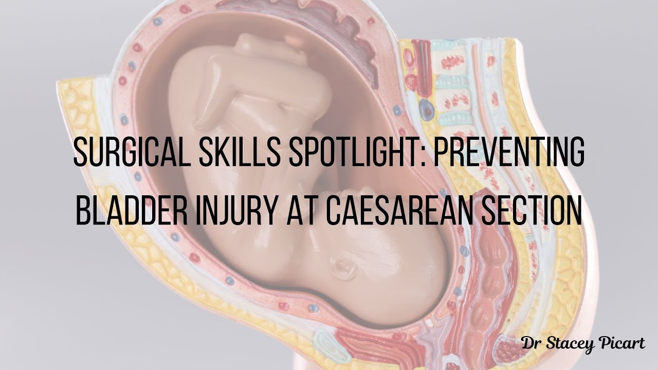 Preventing Bladder Injuries During C-Section: Essential Tips for O&G Doctors