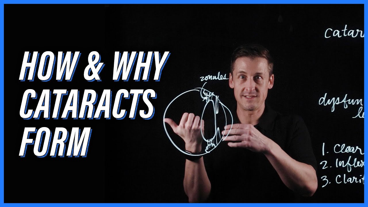 How and why cataracts form in the eye