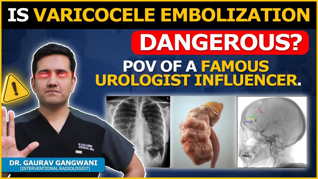 Facts Check, What some famous influencer urologist think about Varicocele Embolization? (IR)