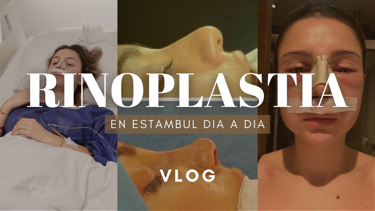 MI RINOPLASTIA EN ESTAMBUL,TURQUIA experiencia | VLOG DIA A DIA | rhinoplasty experience