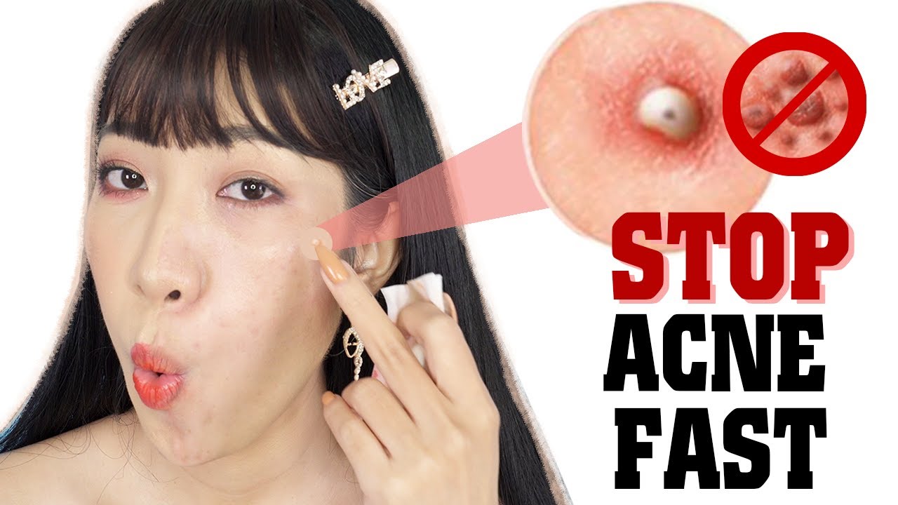 Những Điều N&ecirc;n V&agrave; Kh&ocirc;ng N&ecirc;n Dưỡng Da Sau Mụn [Vanmiu Beauty]