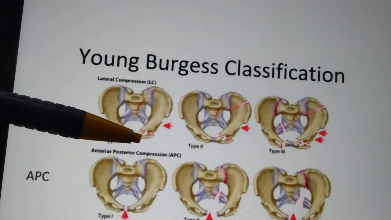 Pelvic fractures classification