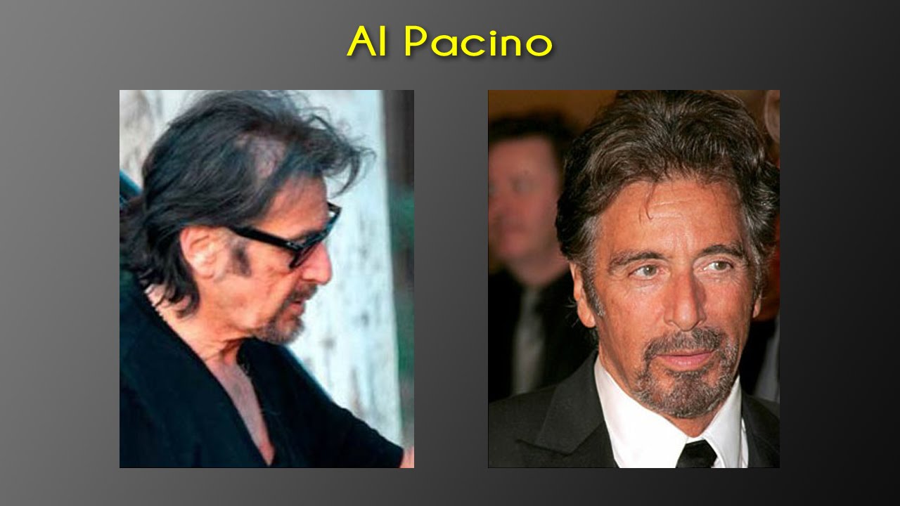 Haartransplantation - Diese Promis haben es getan