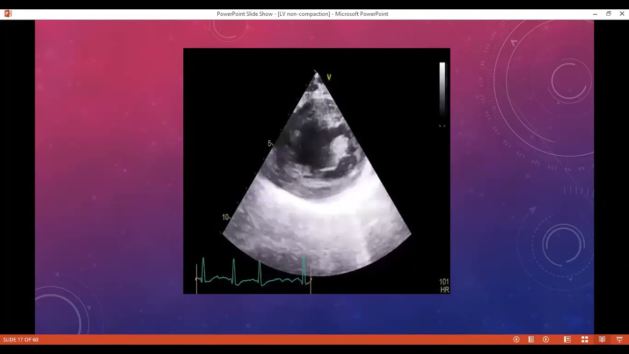 ASU echo conference LV non compaction