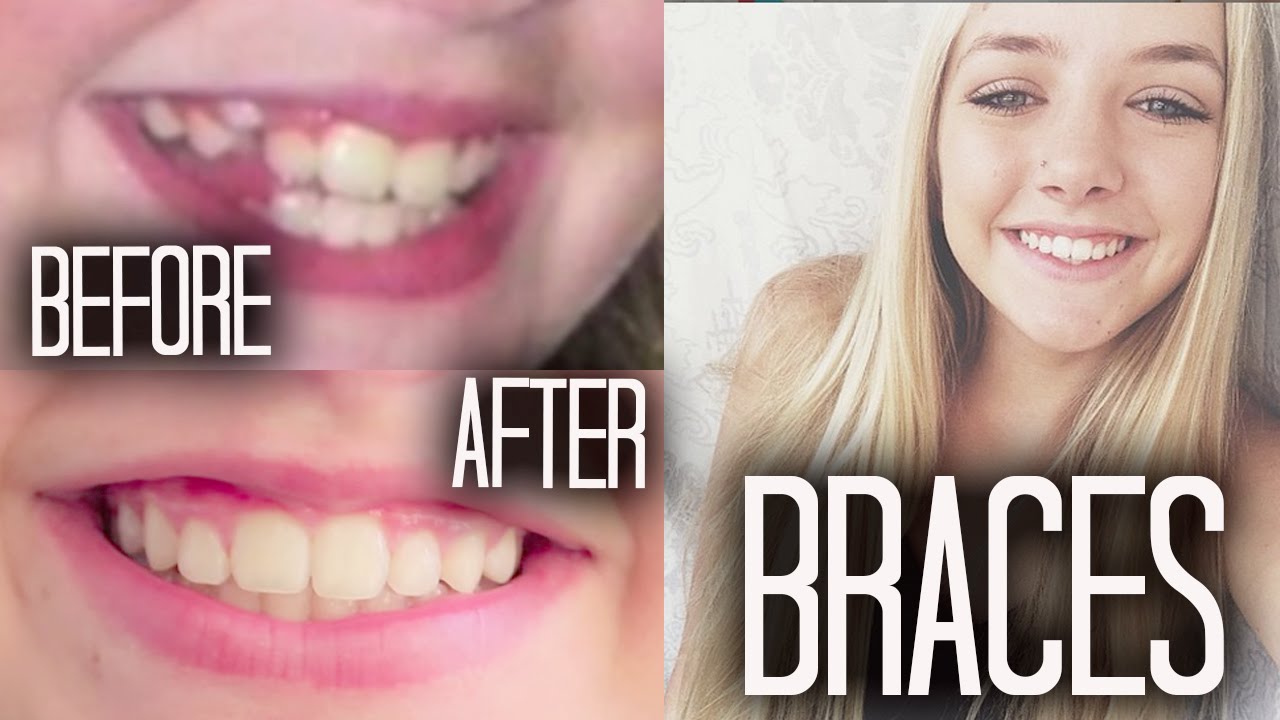Braces 101 + Before & After!