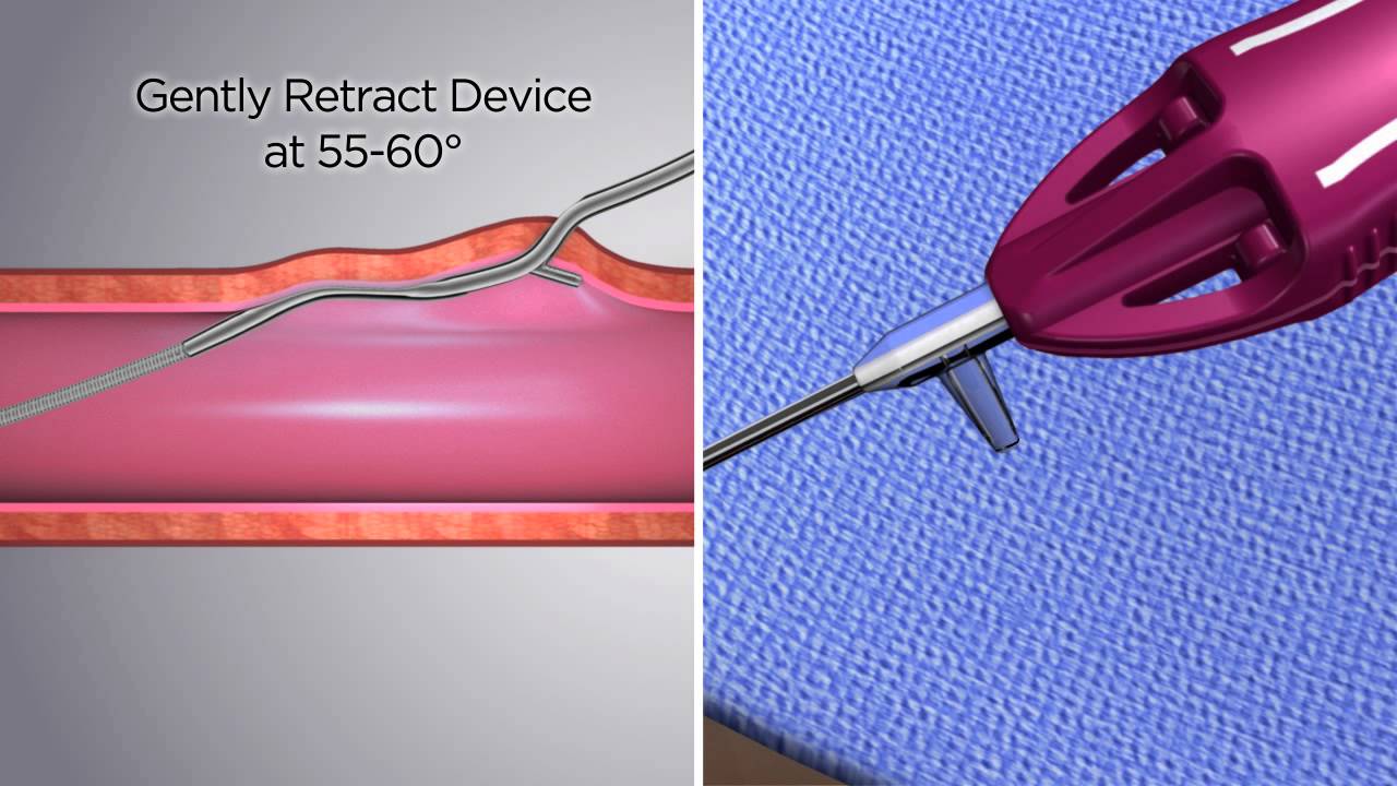 AXERA 2 -- Femoral Artery Access Device