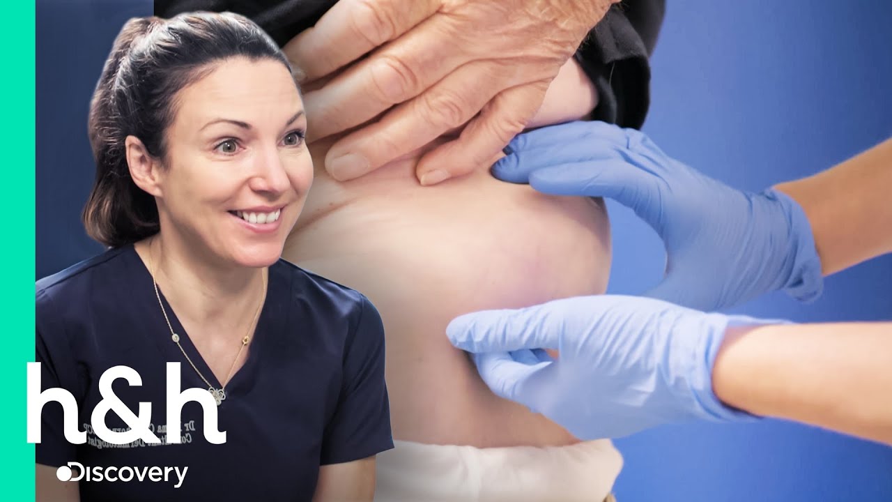 Paciente convive com um lipoma no quadril há 60 anos | Dra. Emma: Uma Questão de Pele | H&H Brasil