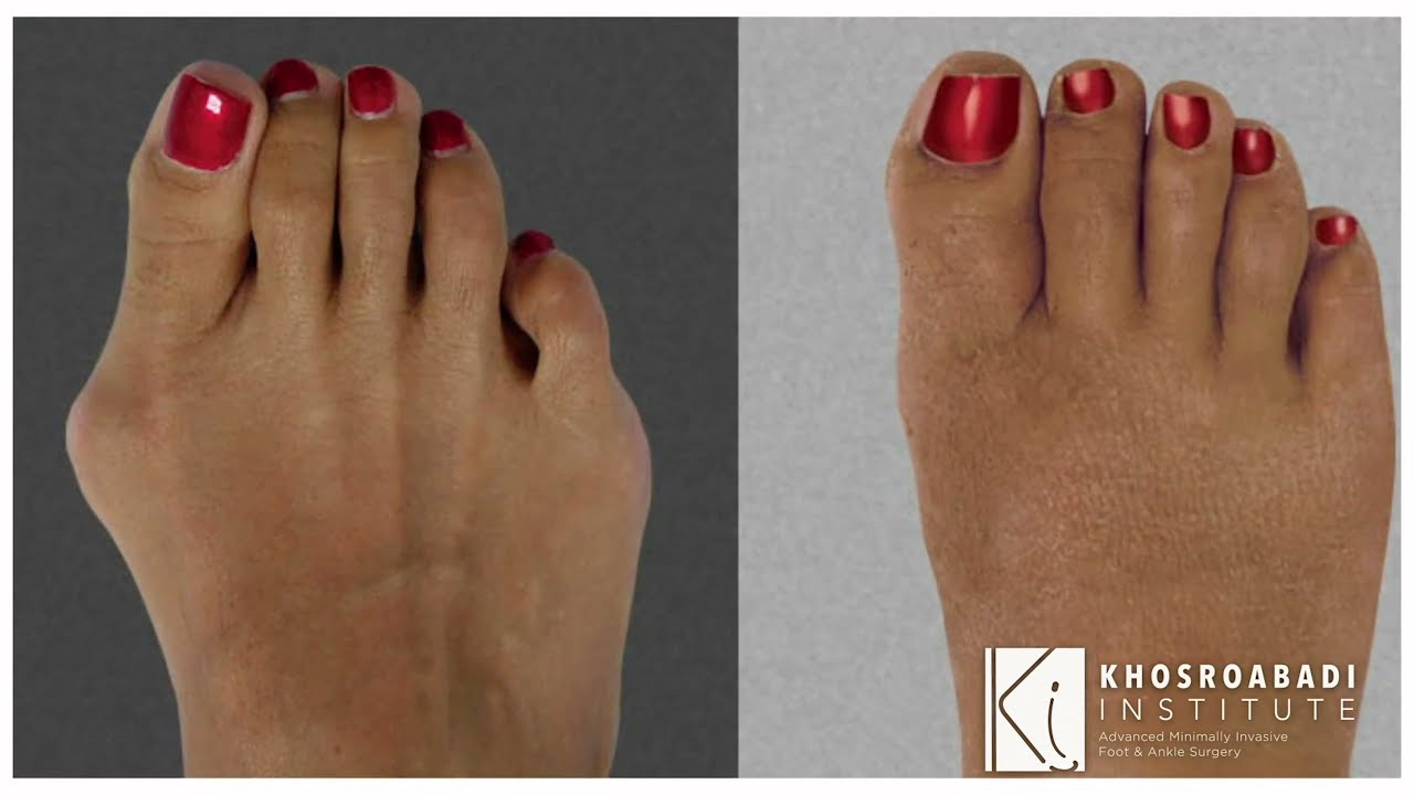 Traditional vs. Minimally Invasive Bunion Surgery: Key DIFFERENCES | Part 2