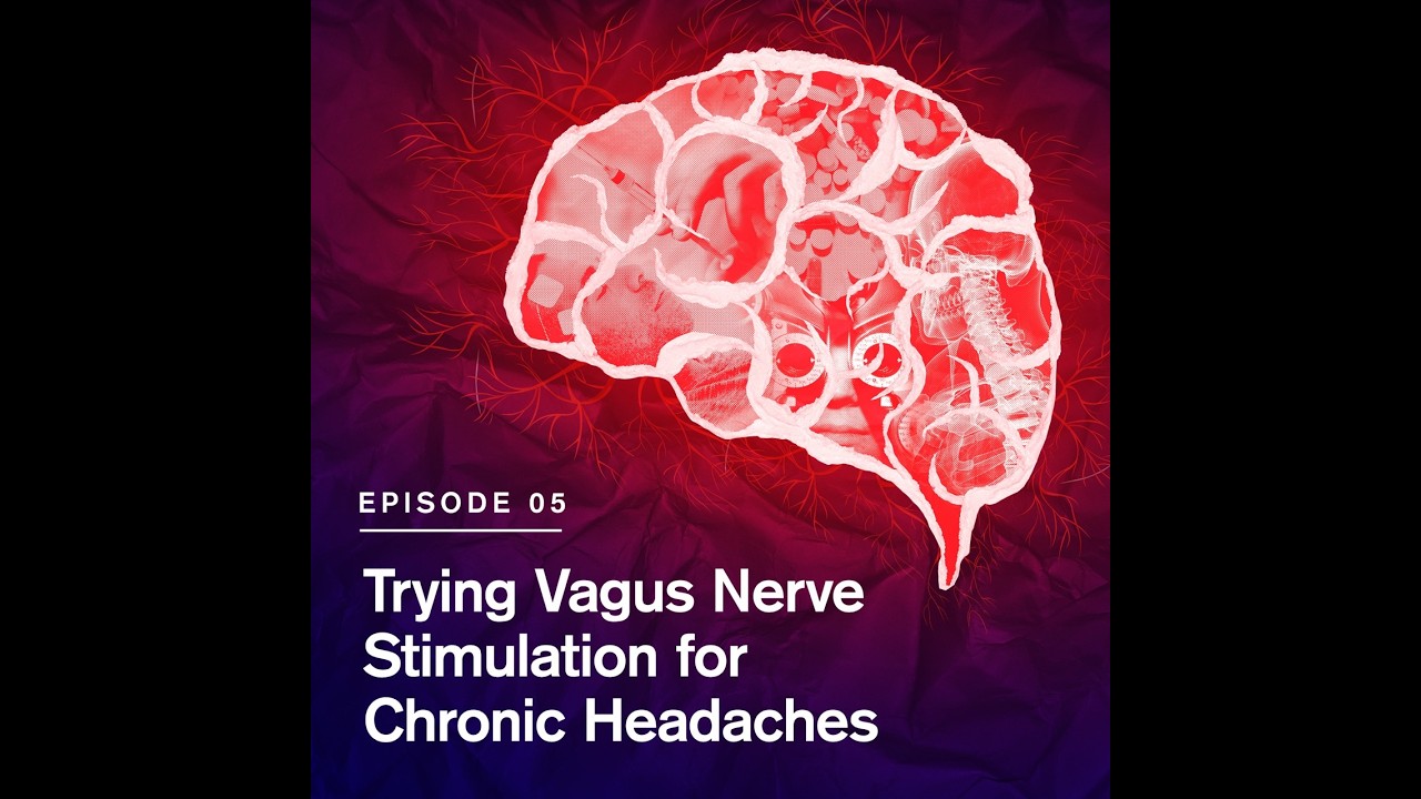 Trying Visual Training for Chronic Headaches | Peter Staats, MD, MBA