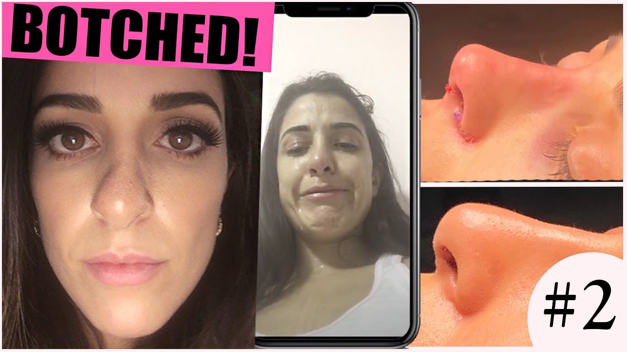 MY NOSE JOB (REVISION RHINOPLASTY) EXPERIENCE IN TURKEY | surgery day & hospital tour | PART 2