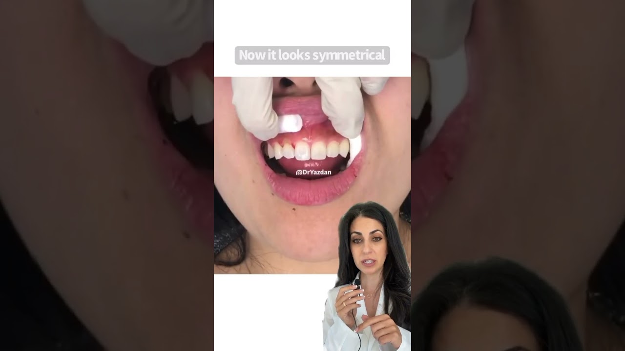 Gum lift | gum contouring laser | laser gum lift | Dr. Yazdan | #cosmeticdentistry small teeth