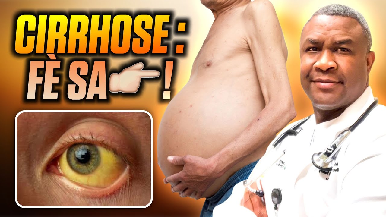 SUPPLEMENT NATUREL POU CIRRHOSE.