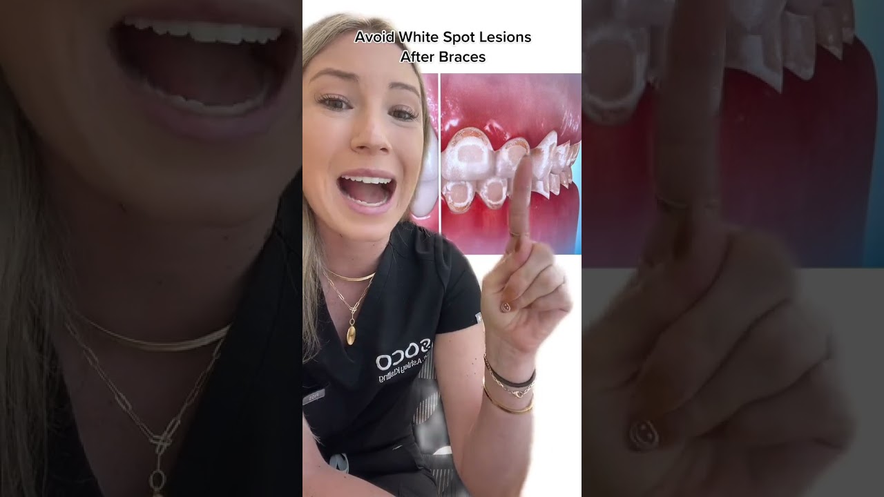 Avoid white spot lesions after braces 