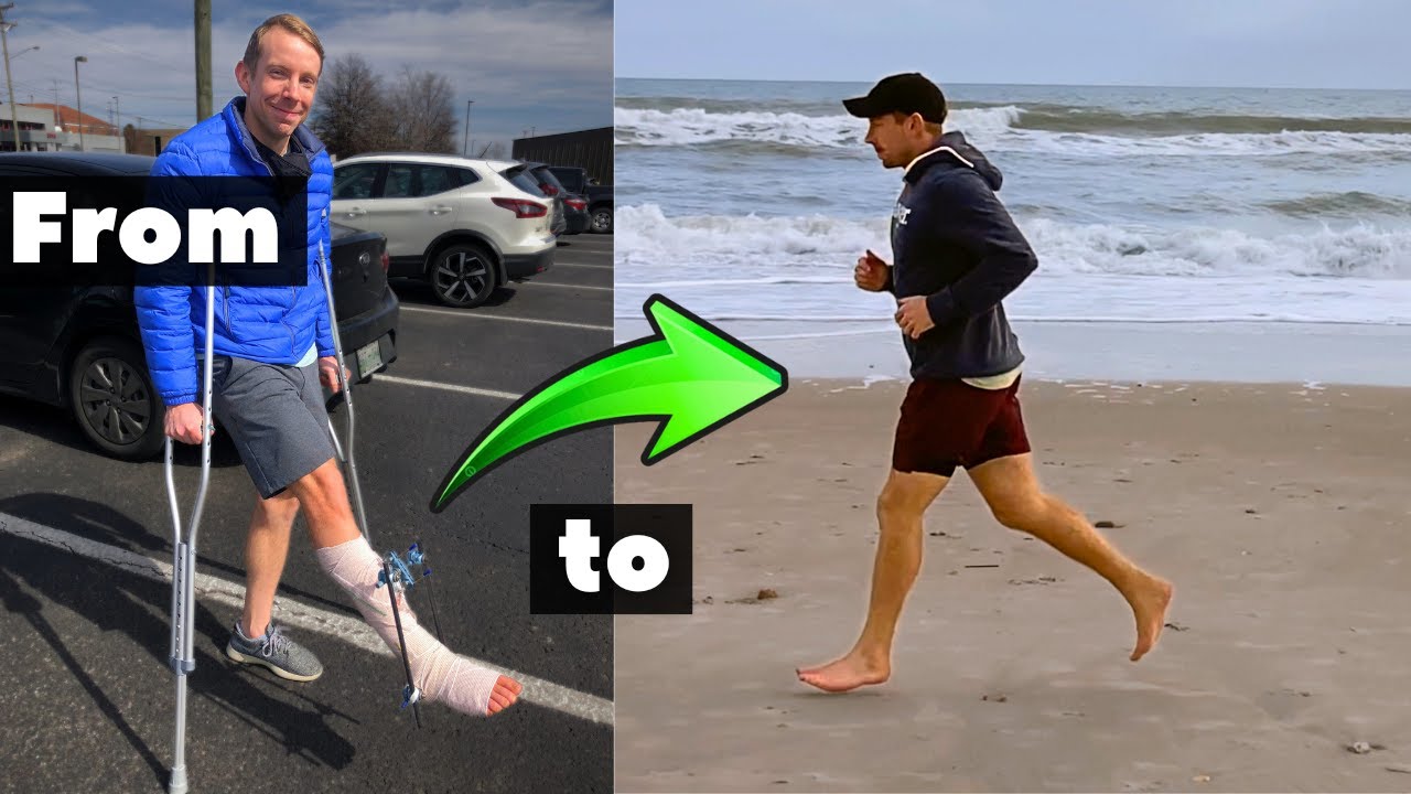 Tib/Fib Fracture Recovery: 3-Year Update