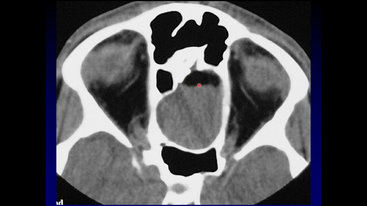 Imaging of the Paranasal Sinuses 4