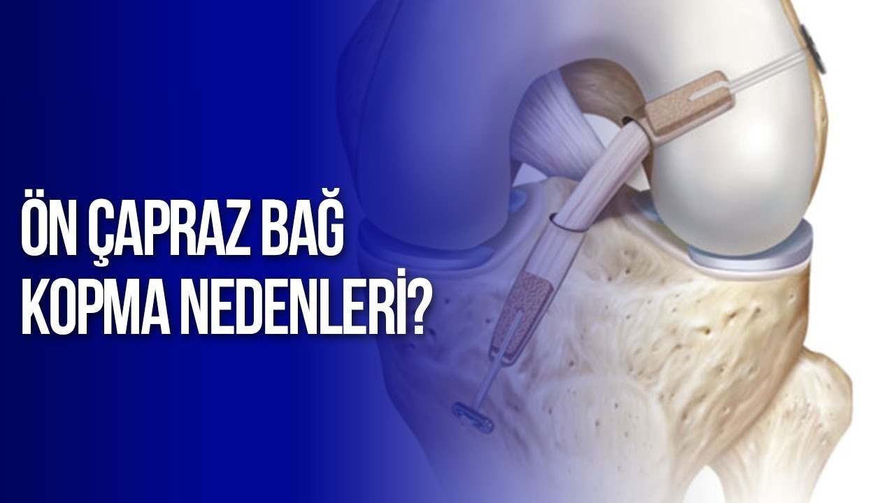 Ön çapraz bağ kopma nedenleri? | Prof. Dr. Yakup YILDIRIM