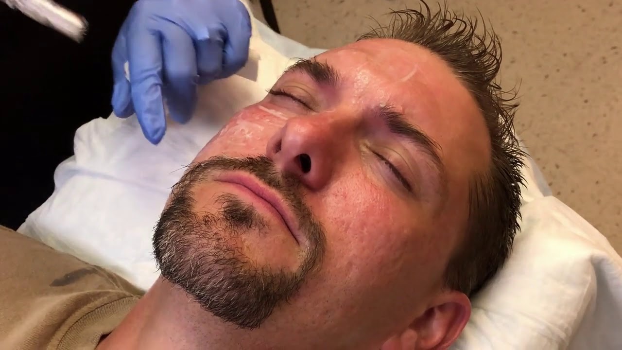 Microneedling, a Collagen Induction Therapy
