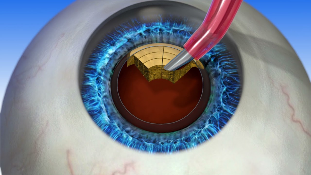 LENSAR Cataract Surgery Patient Animation