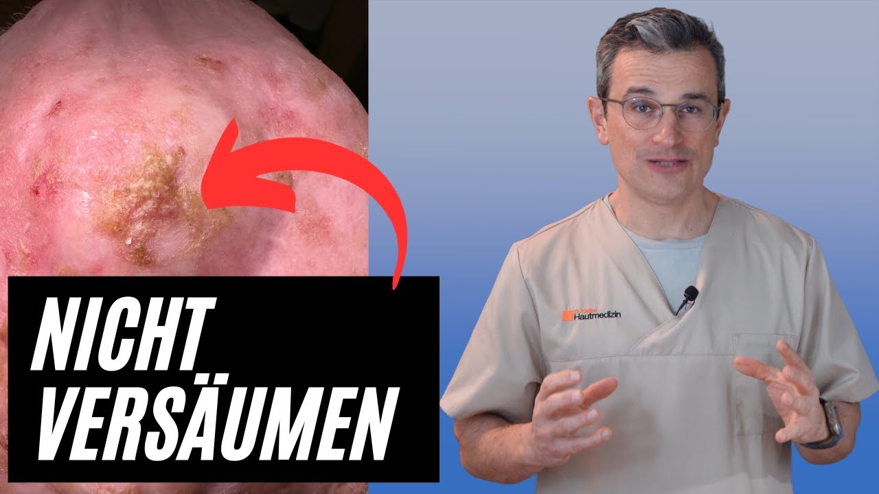 ➡️ 🔎 Das sind schon Hautkrebsvorstufen (von hellem Hautkrebs): Aktinische Keratosen