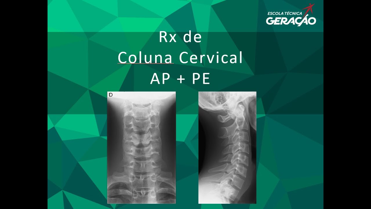 Radiografia da Coluna Cervical - AP + PE