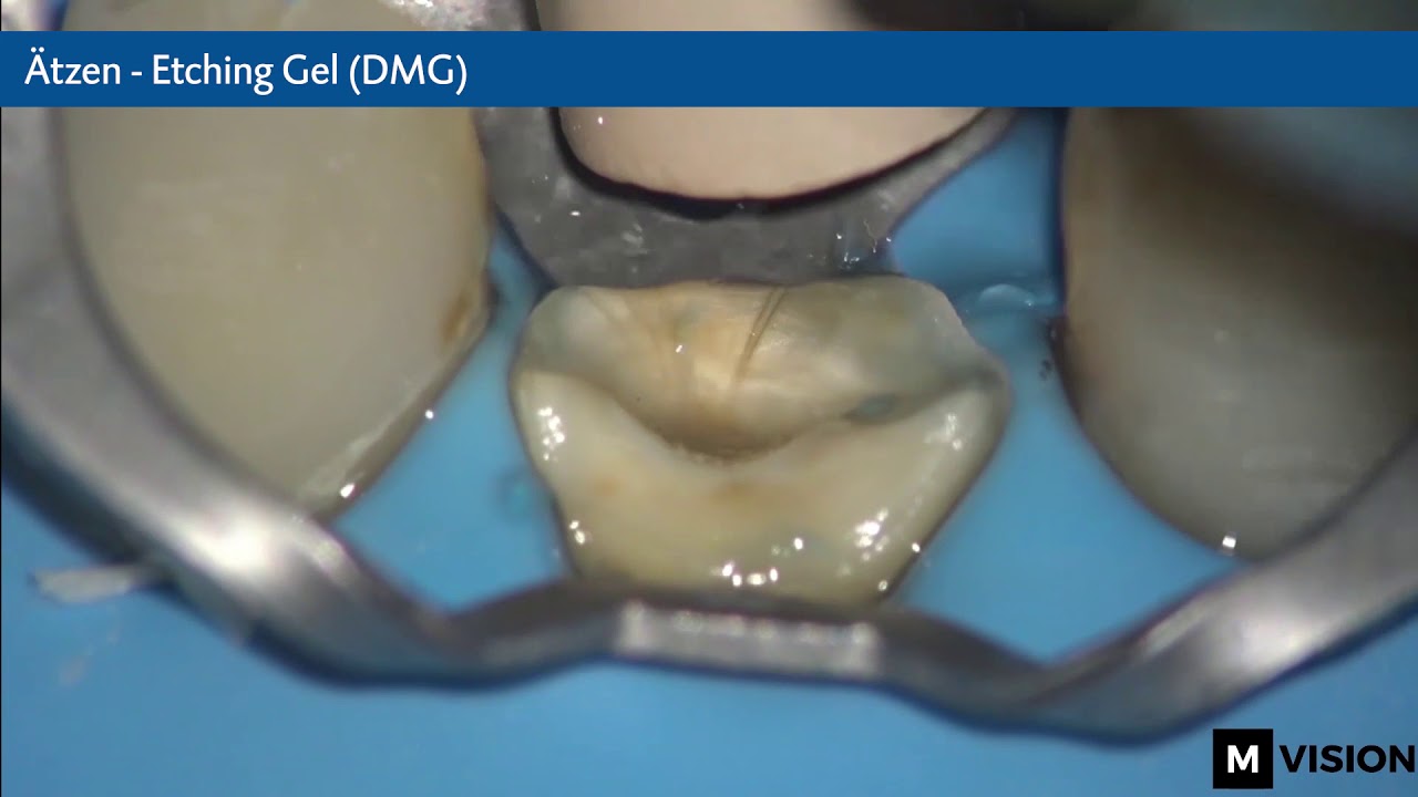 Post-endodontische Versorgung mit der LuxaCore Z Familie von DMG