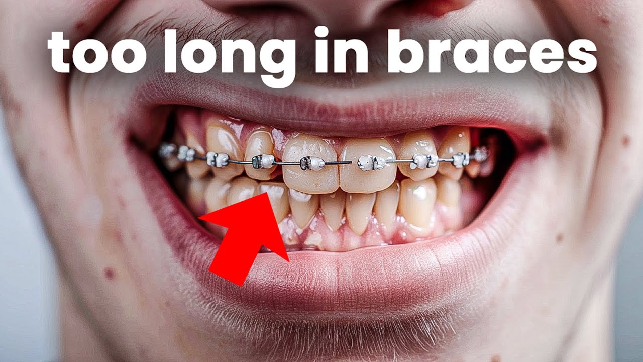 What it looks like when you have braces for too long...