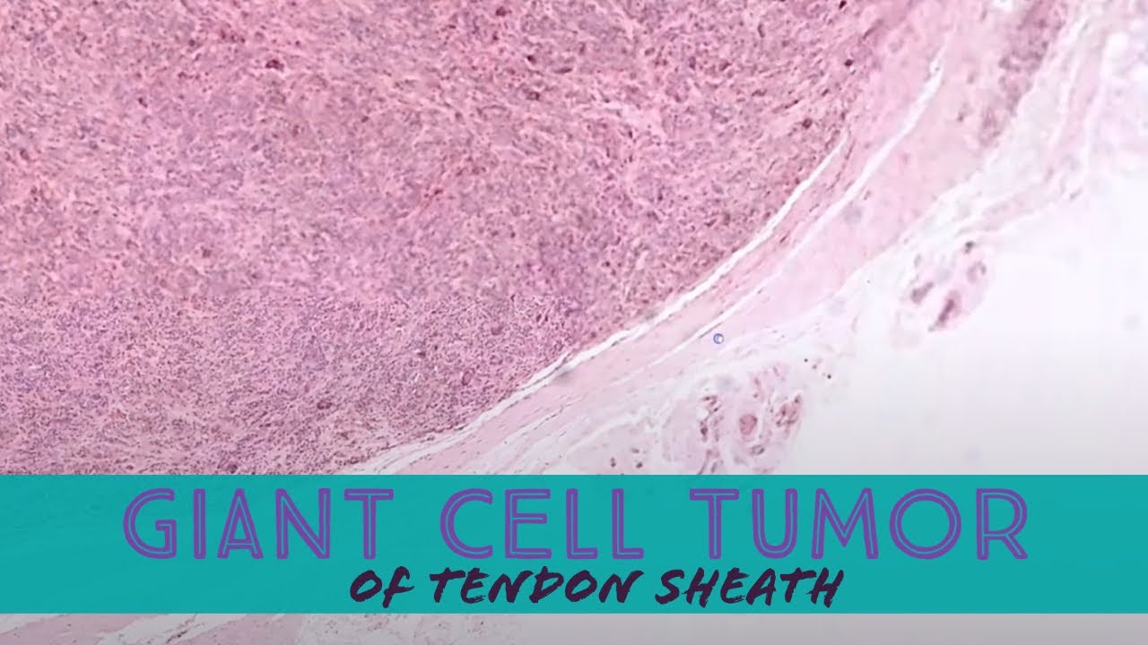 Giant cell tumor of tendon sheath...under the microscope (pathology dermpath dermatopathology)