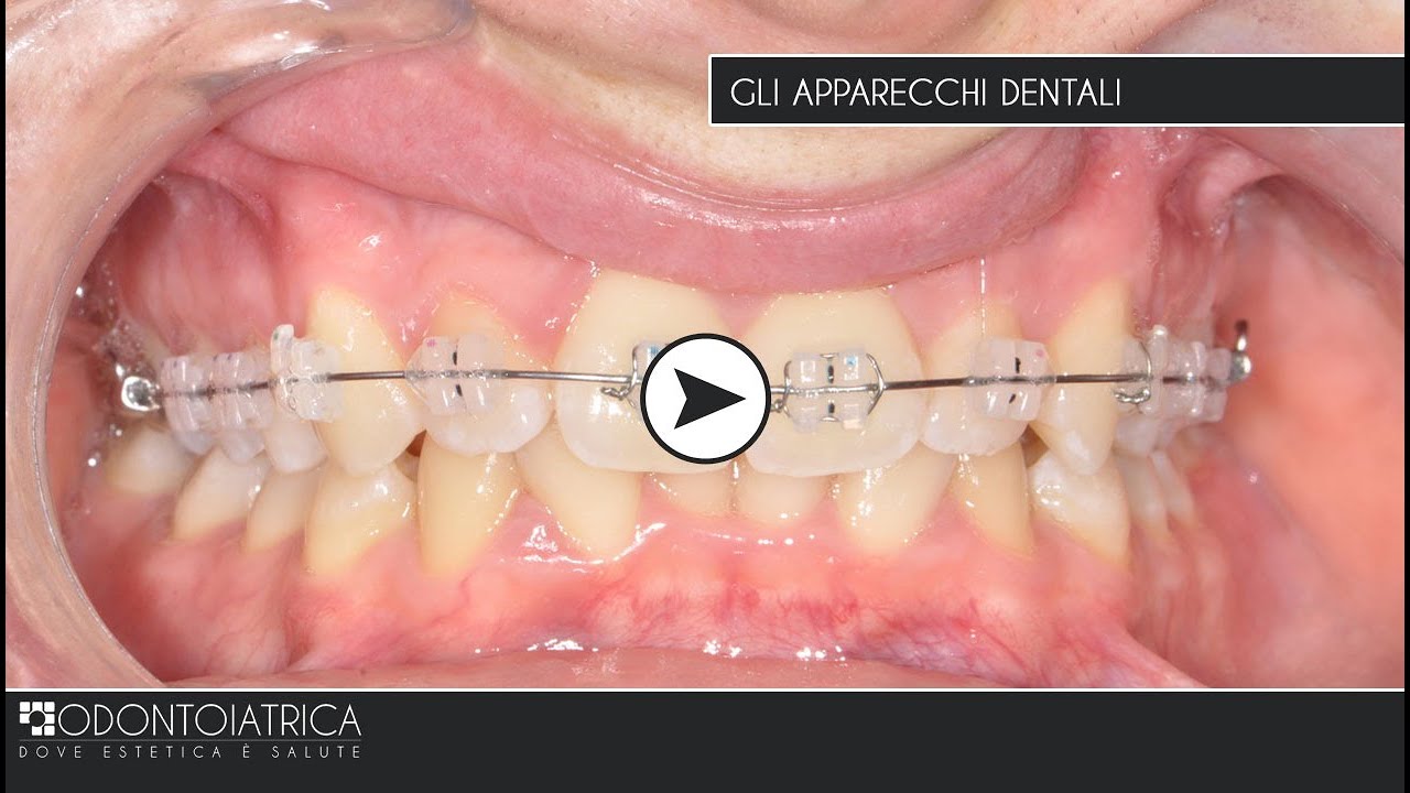 Gli apparecchi dentali - Dott. Alberto De Stefani - Intervista