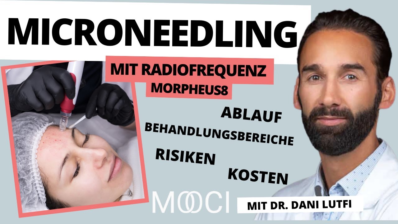 Alles was DU wissen musst! - Microneedling mit Radiofrequenz (Morpheus8)