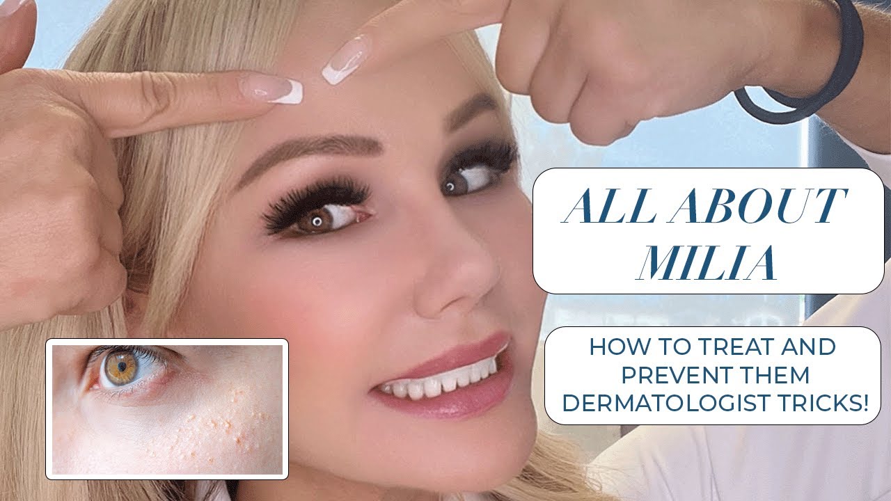 How to treat MILIA! Dermatologist recommends treatments and prevention for milia around the eyes