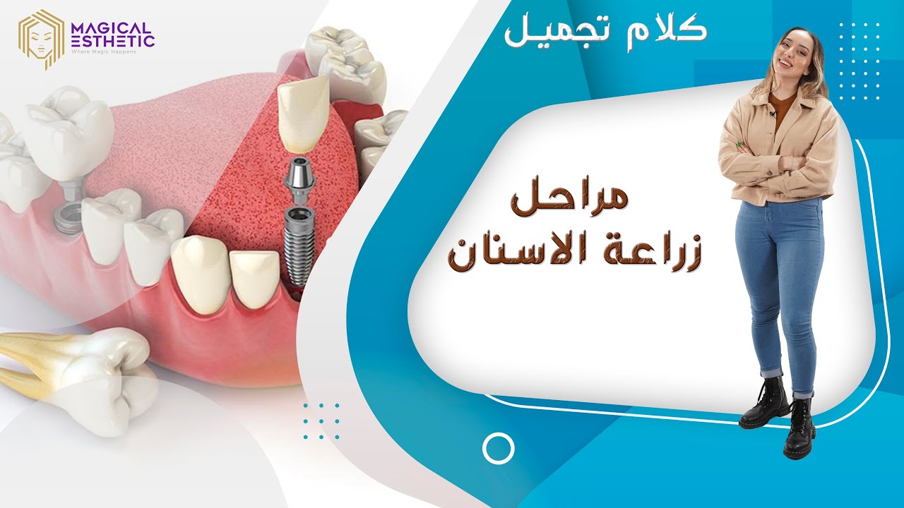 مراحل زراعة الاسنان - كلام تجميل مع ندى عبيد