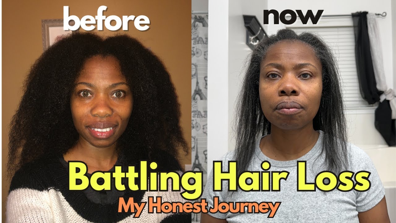 I&rsquo;m Losing My Hair: My Emotional Journey with Female Pattern Hair Loss