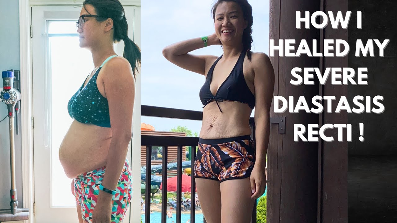 How I Healed My Severe Diastasis Recti (2 times!)