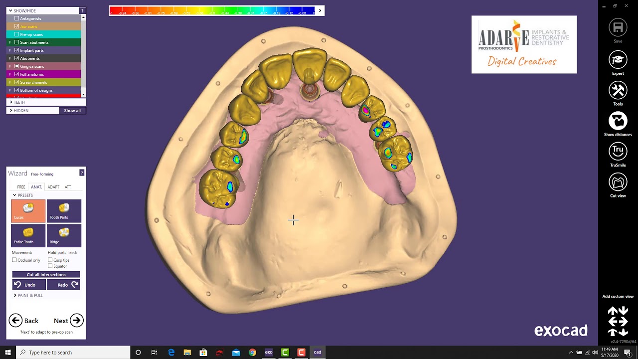 Hybrid Design with Exocad -Dr. Adarve