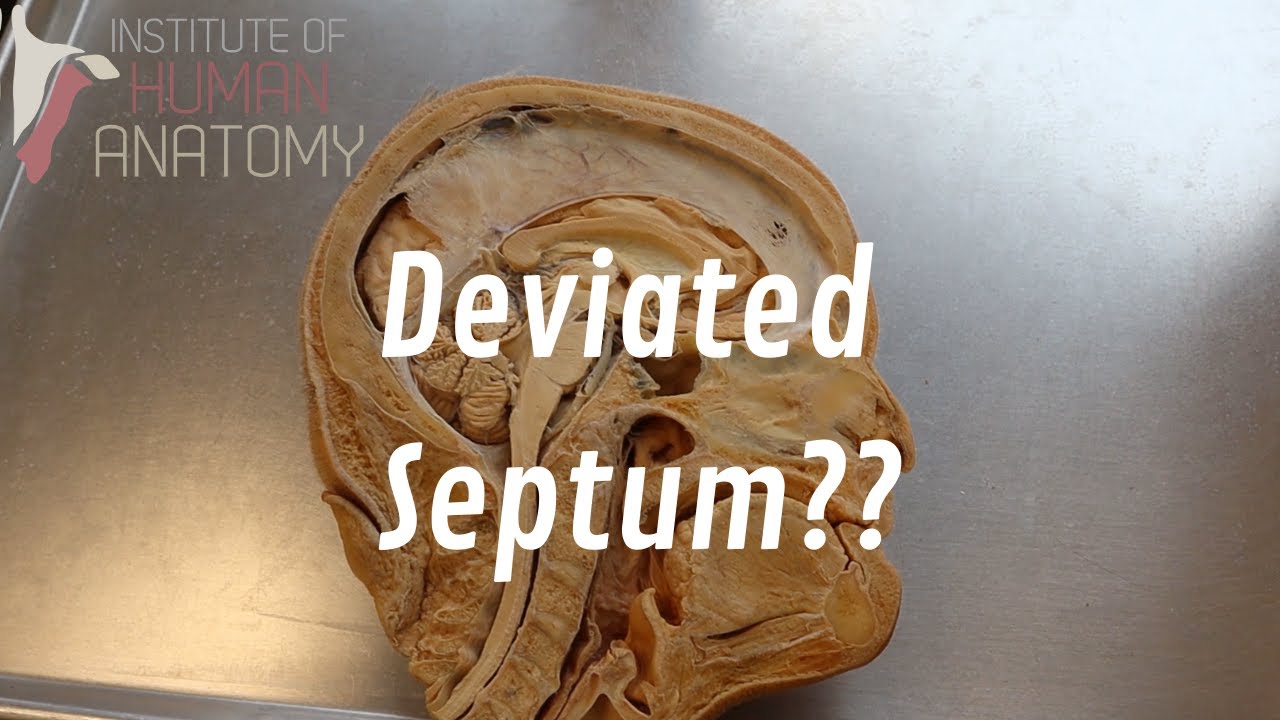 What Is a Deviated Septum??