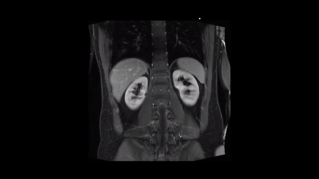 PROTOCOLO RM ABDOMEN ESTANDAR
