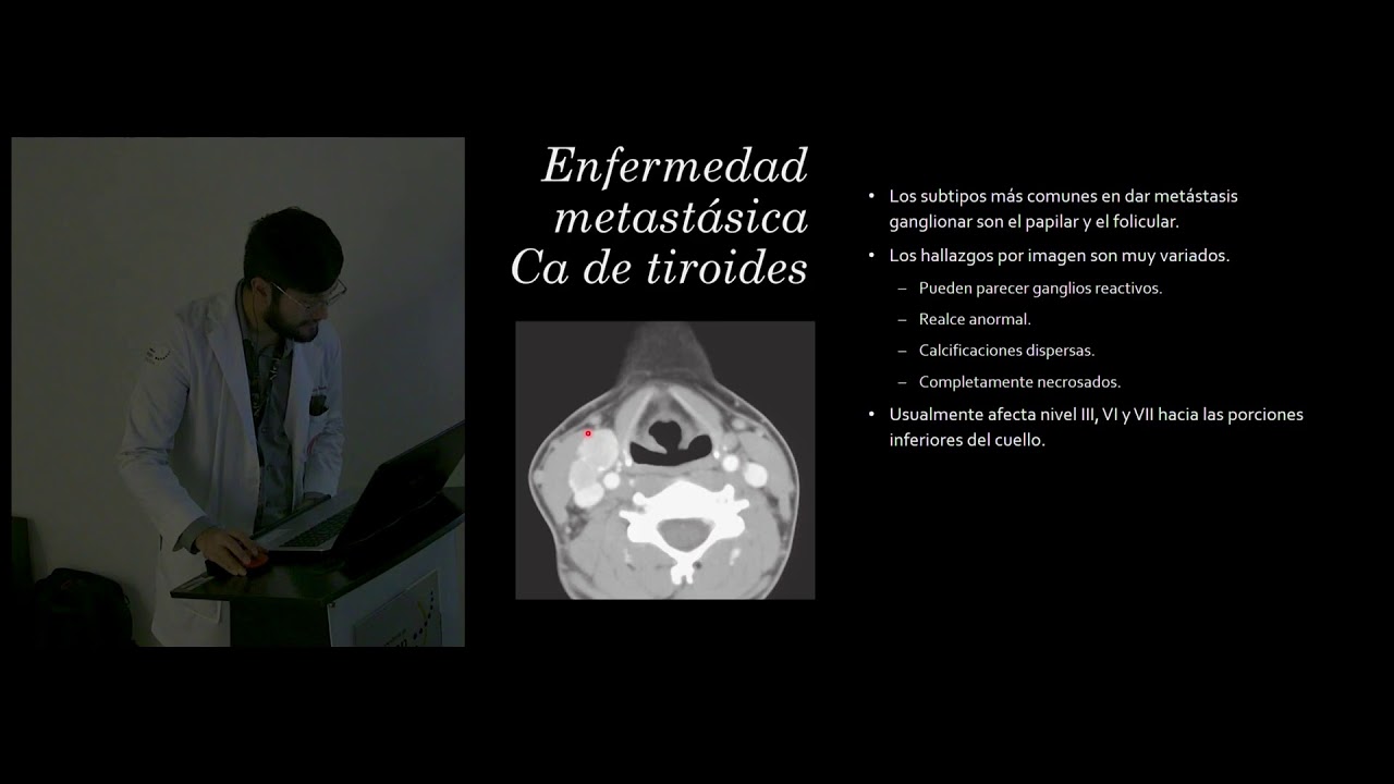 Tema: Evaluación ganglionar de Cabeza y Cuello Dr. Edgar Hernandez