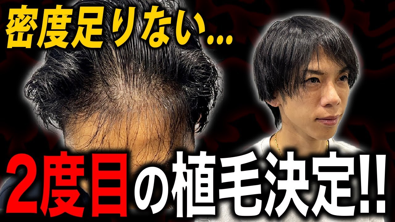 【密度不足】植毛して1年4ヶ月経過したが納得いかず...。悩んだ末に再挑戦！