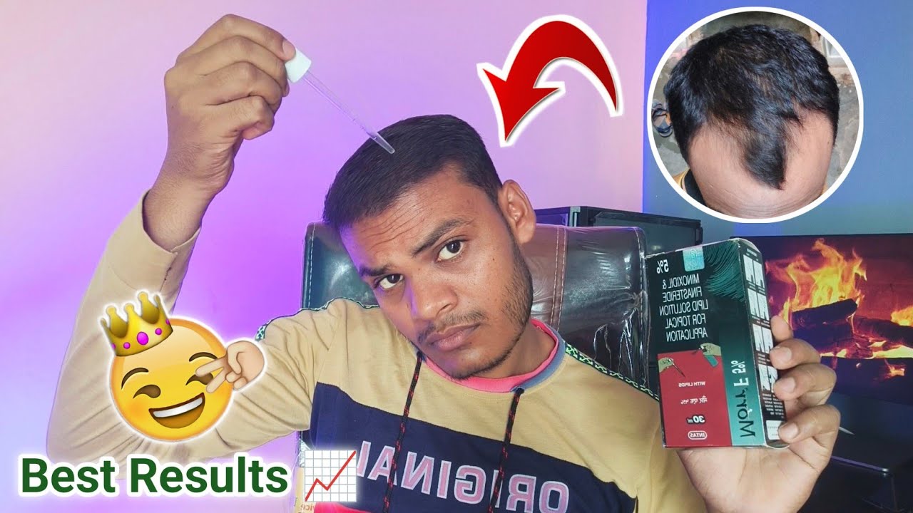 Minoxidil Hair Regrowth Results Raipur | Morr F 5 Results | Hair Transplant Results Before And After