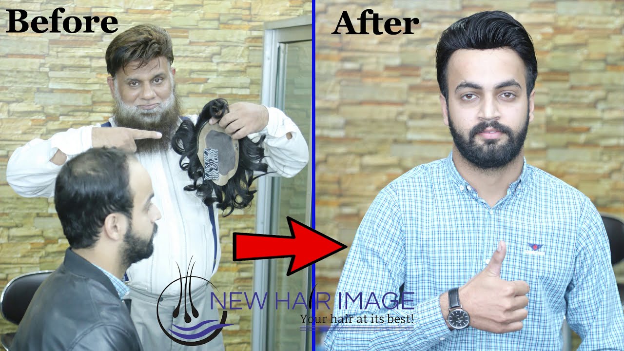 Hair system : Which One Is Batter Hair Patch or Hair Transplant ..?