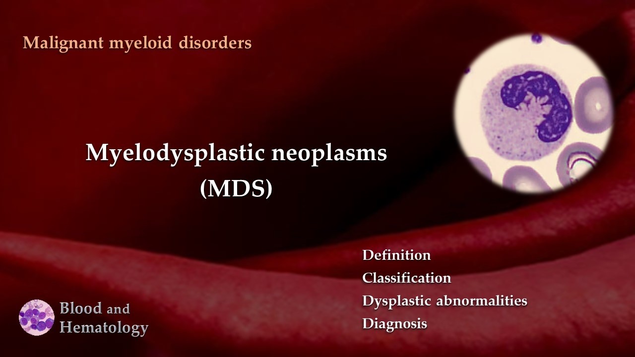 Myelodysplastic neoplasms (MDS)