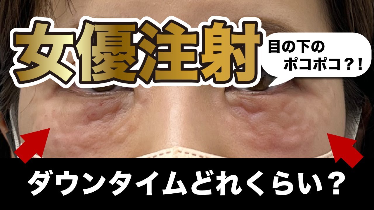 【女優注射】ダウンタイムどれくらい？