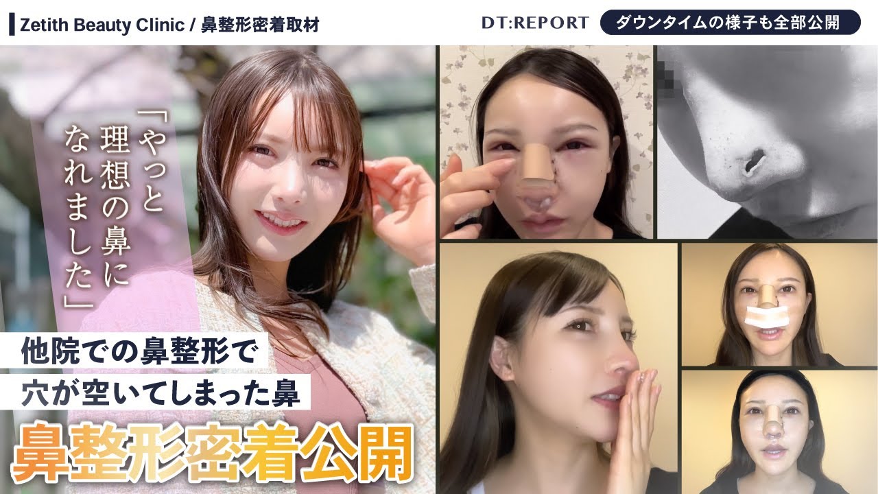 【鼻整形密着】他院での鼻整形で鼻に穴が…【鼻整形 / 鉄医師】三度目の鼻整形で理想の鼻を手に入れる女性の物語【修正手術】