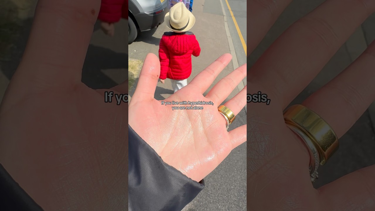 Do you suffer from excessively sweaty hands or feet? #hyperhidrosis