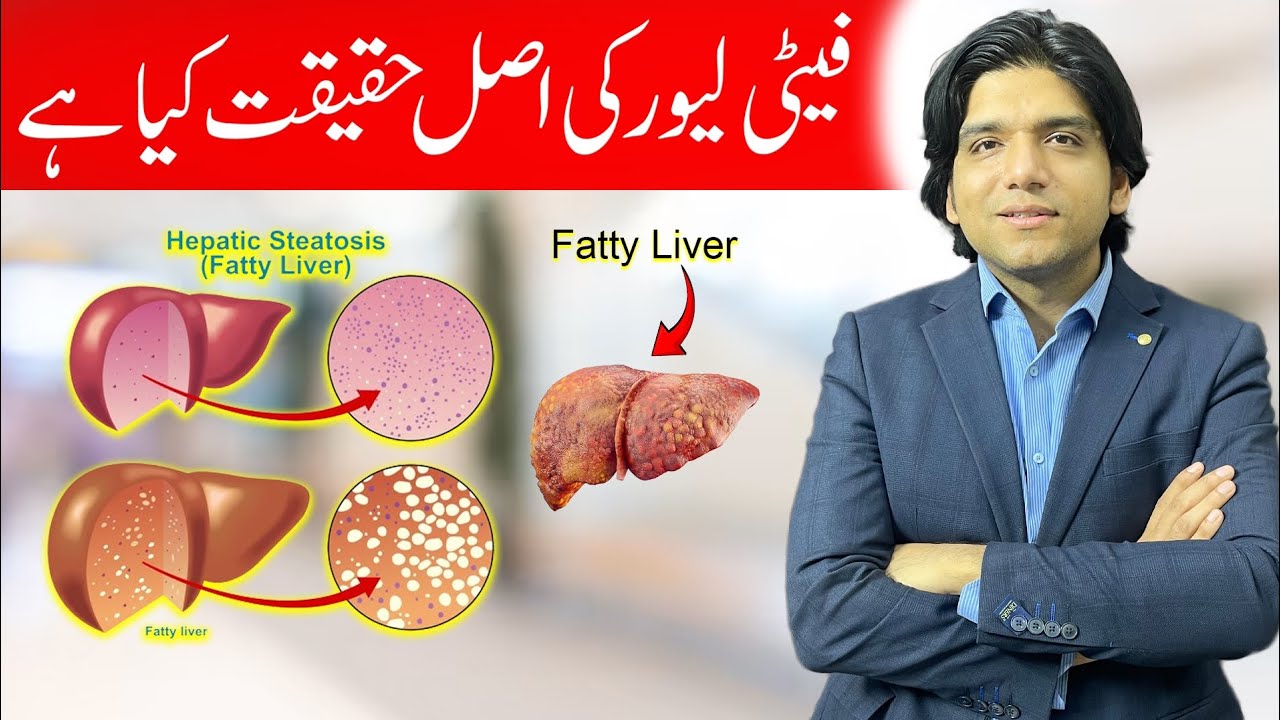 Fatty Liver ki Asal Haqiqat kya hy? || Dr Affan Qaiser